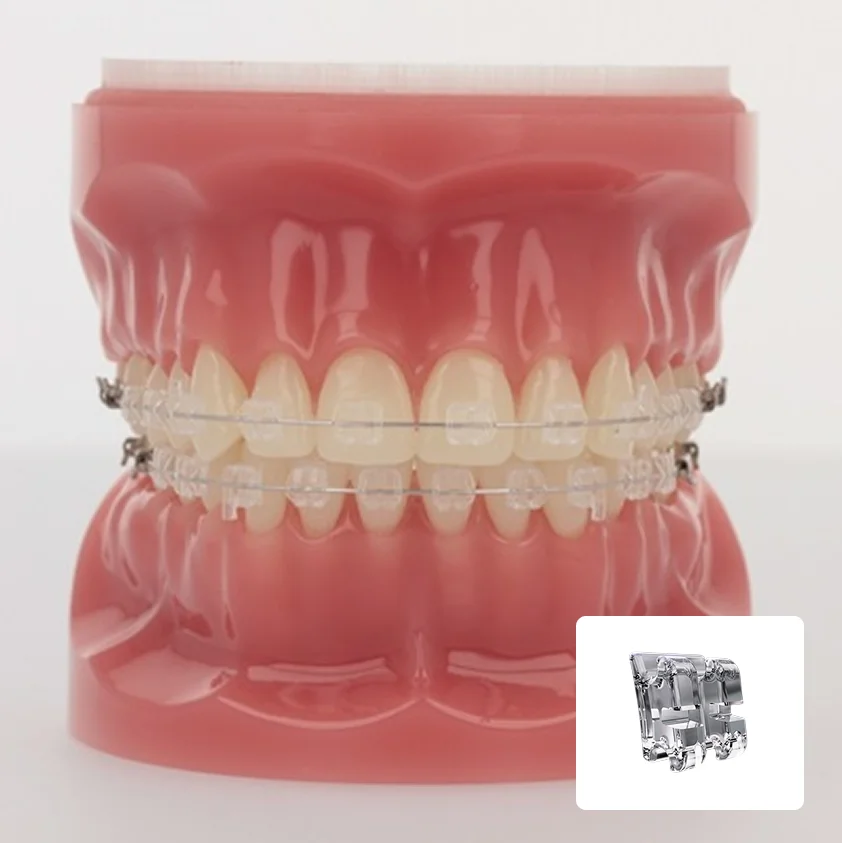 clear-ceramic-braces